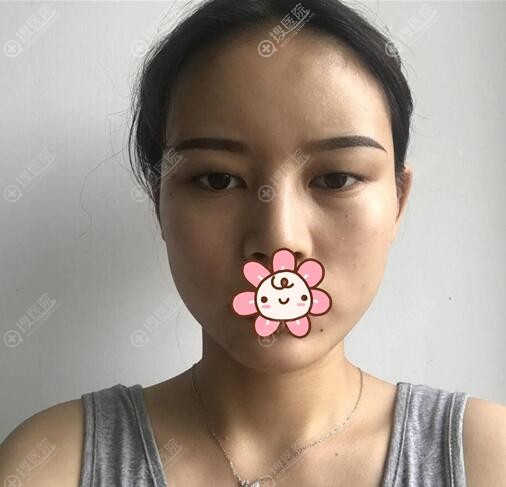 找胡珍珍做眼睛前的照片 找胡珍珍做眼睛前的照片