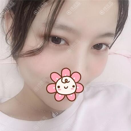 深圳瑞尼丝埋线双眼皮44天效果 深圳瑞尼丝埋线双眼皮44天效果