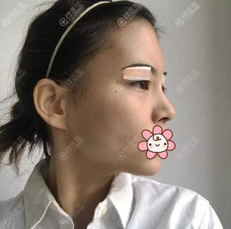 胡珍珍埋线双眼皮术后即刻 胡珍珍埋线双眼皮术后即刻