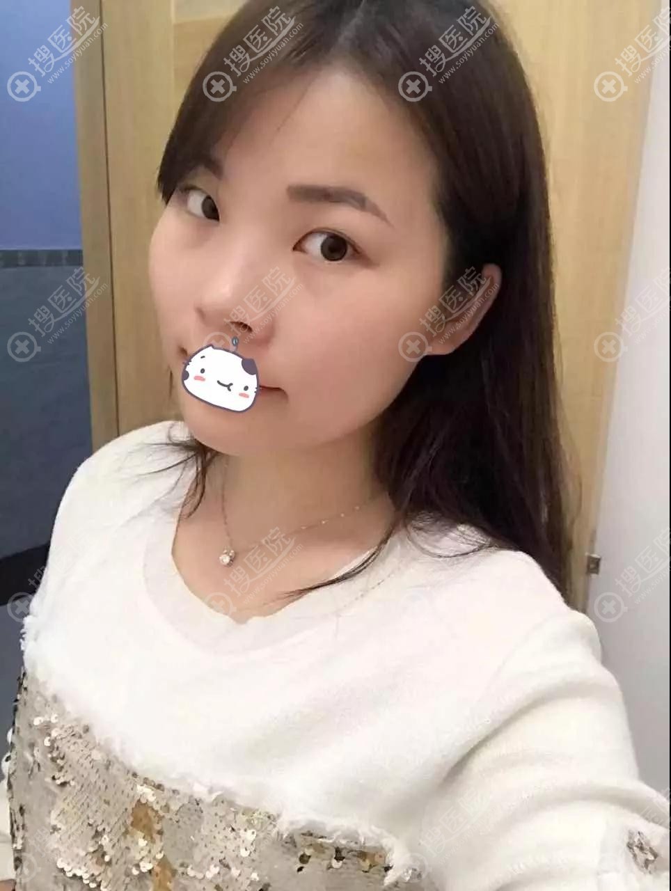 不甘平凡我找口碑不错的江门梦想做了双眼皮隆鼻手术