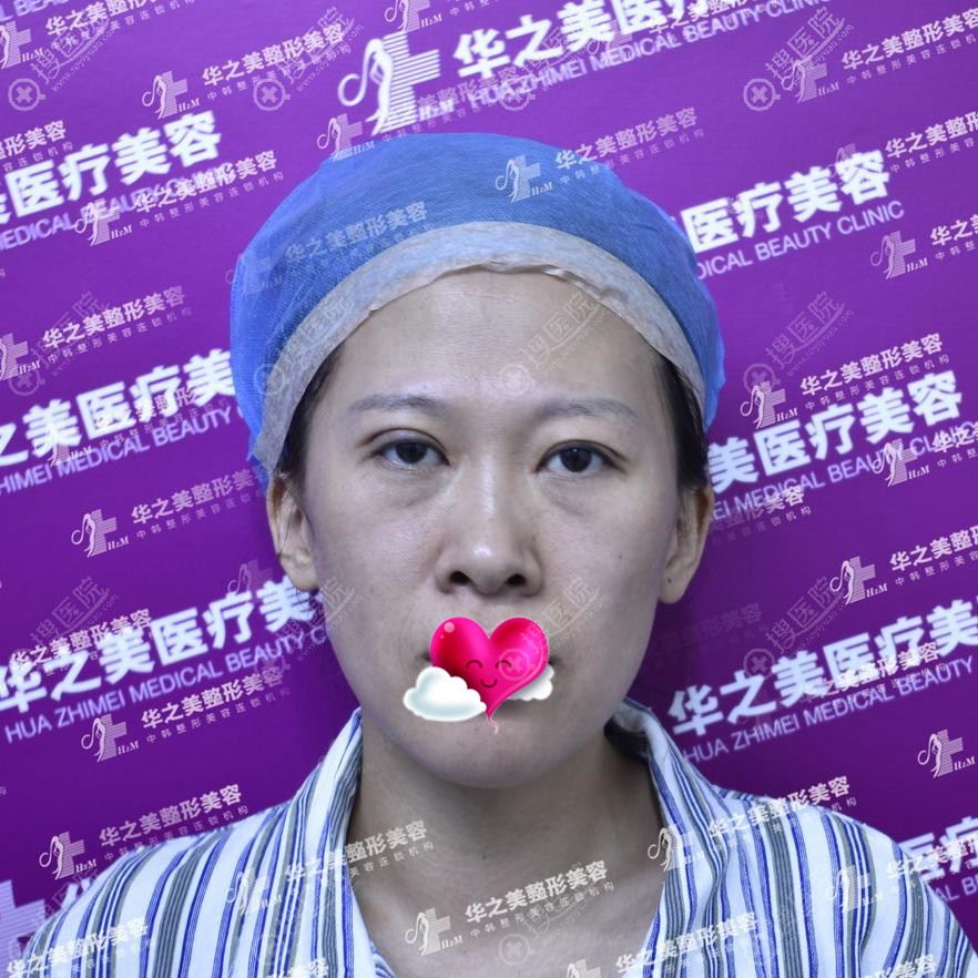 面部干瘪,到义乌华之美找汪波宇做自体脂肪填充面部后超显年轻