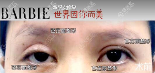 南宁芭芘丽整形双眼皮修复真人案例 南宁芭芘丽整形双眼皮修复真人案例