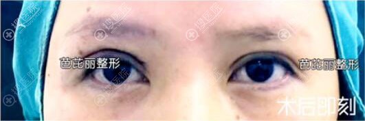 南宁芭芘丽双眼皮失败修复术后即刻效果图 南宁芭芘丽双眼皮失败修复术后即刻效果图