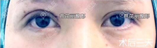 南宁双眼皮失败修复效果怎么样?南宁芭芘丽眼部修复案例 南宁双眼皮失败修复效果怎么样?南宁芭芘丽眼部修复案例