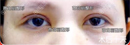 南宁芭芘丽割双眼皮效果好吗?眼修复案例术后恢复图 南宁芭芘丽割双眼皮效果好吗?眼修复案例术后恢复图