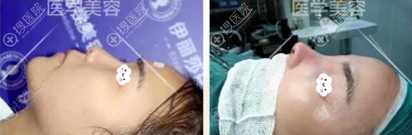 惠州伊丽莎白鼻综合隆鼻真人案例 惠州伊丽莎白鼻综合隆鼻真人案例