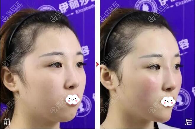 惠州伊丽莎白玻尿酸垫下巴案例效果对比图 惠州伊丽莎白玻尿酸垫下巴案例效果对比图
