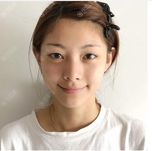 张霞飞不在杭州格莱美了,看我在杭州美莱找她做的双眼皮好看吗