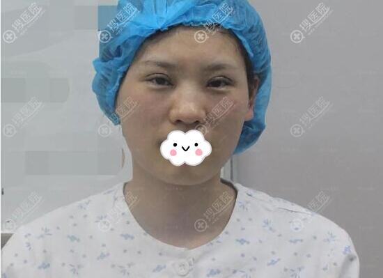 侯舍予双眼皮手术即刻照片 侯舍予双眼皮手术即刻照片