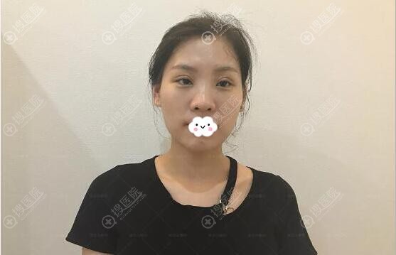 切开双眼皮术后7天恢复情况 切开双眼皮术后7天恢复情况