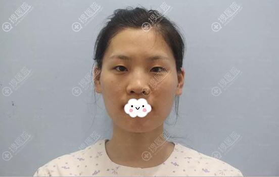 贴双眼皮贴导致眼皮松弛 贴双眼皮贴导致眼皮松弛