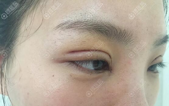 六度美眼术后3天眼部特写 六度美眼术后3天眼部特写