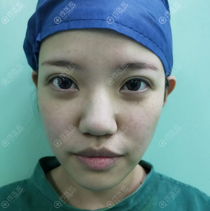 听说上海丽质是正规整形医院后找卢九宁做了耳软骨鼻综合隆鼻