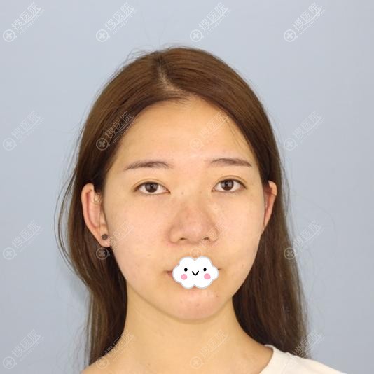 案例评论花1W多找宁波薇琳张广巍进口假体+肋软骨隆鼻价格贵吗