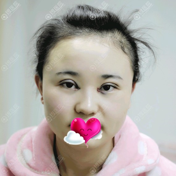 <!--<i data=20240710 data-id=12318></i>-->双眼皮术后即刻 <!--<i data=20240710 data-id=12318></i>-->双眼皮术后即刻