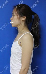 宁波壹加壹假体隆胸价格4980是真的 看院长给我做的效果怎么样