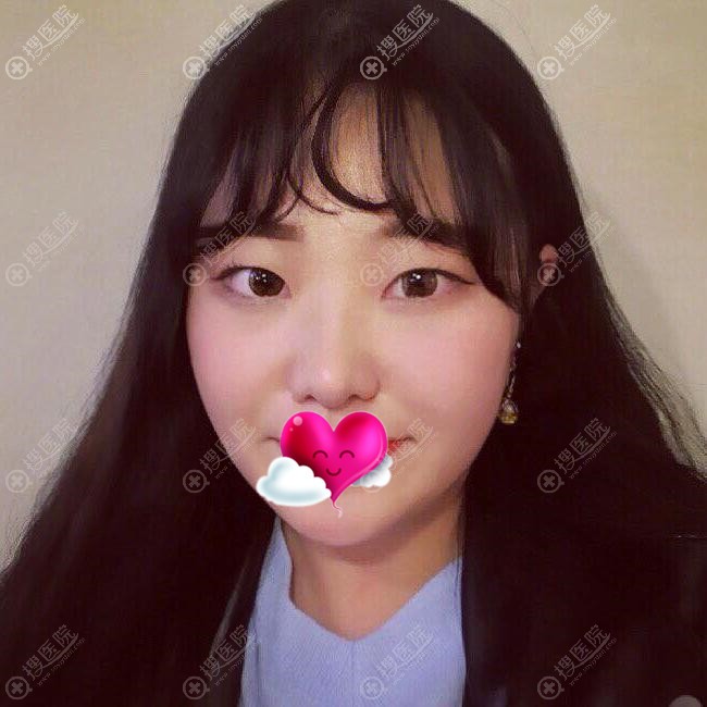 扬州美贝尔做活动吸引我注射,咨询小姐姐推荐我找张成春