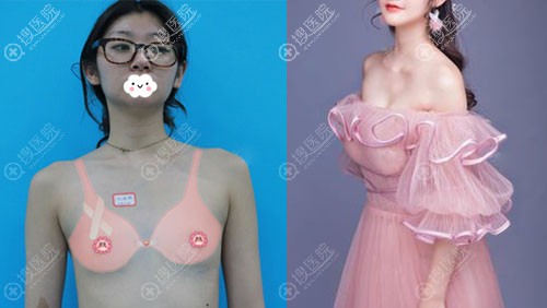 <!--<i data=20240710 data-id=12048></i>-->彭丽霞假体隆胸真人案例 <!--<i data=20240710 data-id=12048></i>-->彭丽霞假体隆胸真人案例