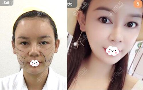 <!--<i data=20240710 data-id=12048></i>-->面部埋线线雕提升真人案例 <!--<i data=20240710 data-id=12048></i>-->面部埋线线雕提升真人案例