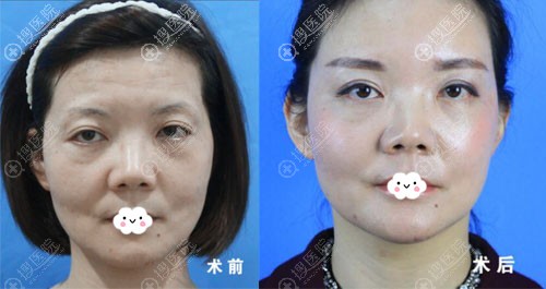 <!--<i data=20240710 data-id=12048></i>-->自体脂肪面部填充案例效果对比图 <!--<i data=20240710 data-id=12048></i>-->自体脂肪面部填充案例效果对比图