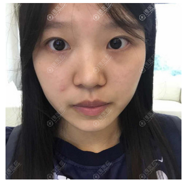 西安同舟医院整形美容科双眼皮案例术前照片 西安同舟医院整形美容科双眼皮案例术前照片