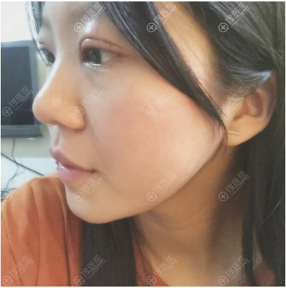 西安同舟医院整形美容科双眼皮术后两天效果 西安同舟医院整形美容科双眼皮术后两天效果