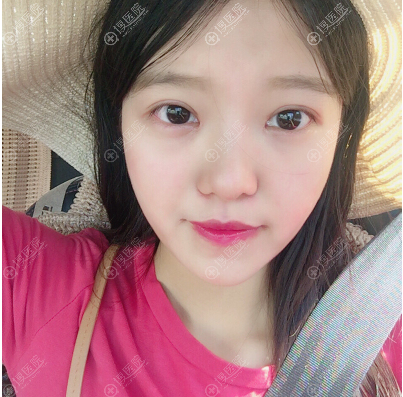 西安同舟医院整形美容科双眼皮案例 西安同舟医院整形美容科双眼皮案例