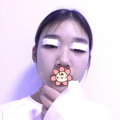 贵阳美贝尔双眼皮术后即刻 贵阳美贝尔双眼皮术后即刻