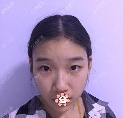 全切双眼皮术前照片 全切双眼皮术前照片