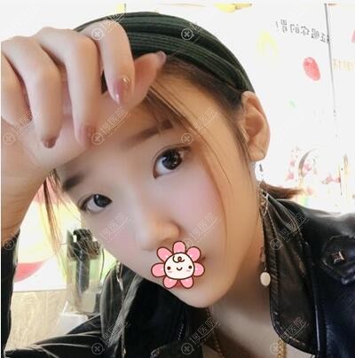 全切双眼皮术后一个月恢复照 全切双眼皮术后一个月恢复照