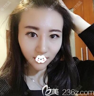 杨万忠隆鼻丰下巴术后半个月 杨万忠隆鼻丰下巴术后半个月