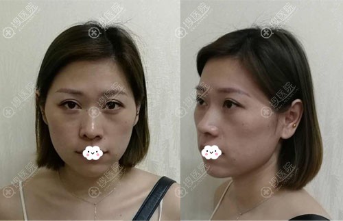 黄良飞纳米脂肪填充案例图了解杭州时光自体脂肪面部填充怎么样