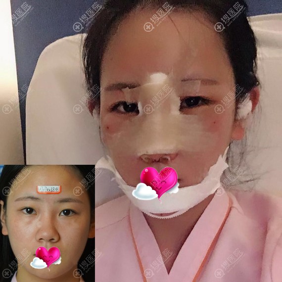 面部扁平的我到重庆艺星垫下巴2个月,变成一个精致的猪猪女孩
