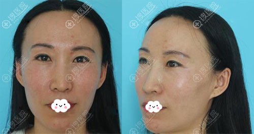 医美从业者也找宁波韩美王用洪做自体脂肪面部填充看效果怎么样