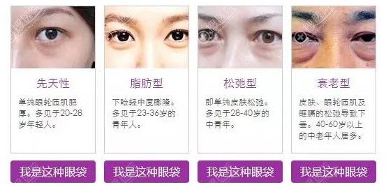 眼袋都有那些类型 眼袋都有那些类型