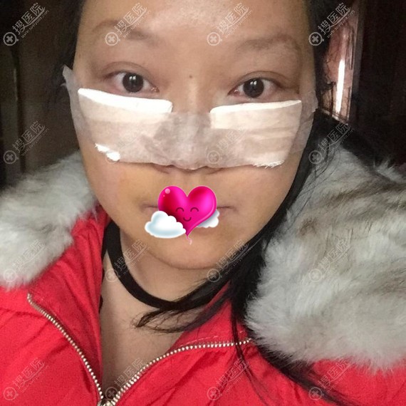 芜湖伊莱美内路祛眼袋术后 芜湖伊莱美内路祛眼袋术后