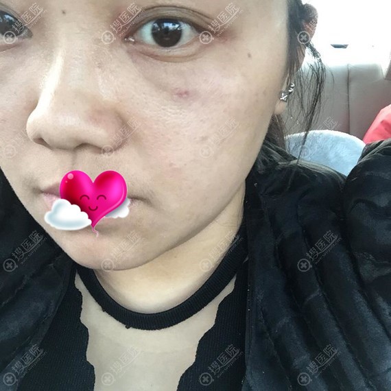 芜湖伊莱美内路祛眼袋3天的效果 芜湖伊莱美内路祛眼袋3天的效果