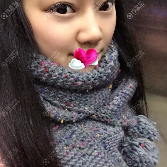 芜湖伊莱美<!--<i data=20240710 data-id=17317></i>-->内路祛眼袋恢复效果 芜湖伊莱美<!--<i data=20240710 data-id=17317></i>-->内路祛眼袋恢复效果