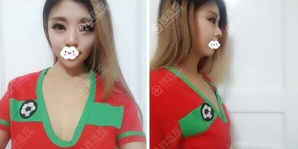 找深圳恩吉娜张锋做了自体脂肪丰胸我就是性感的代名词