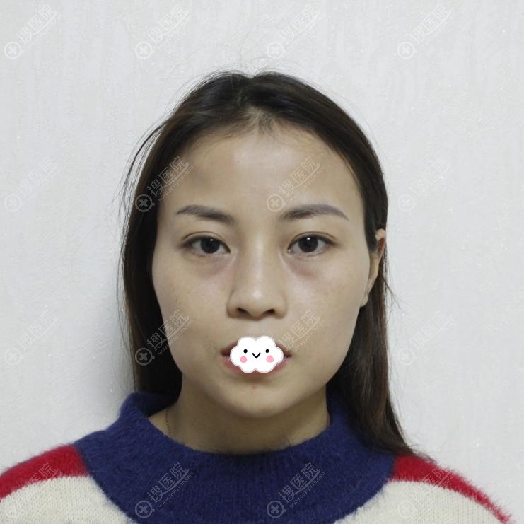 成都艾米丽潘红伟自体脂肪面部填充案例 成都艾米丽潘红伟自体脂肪面部填充案例