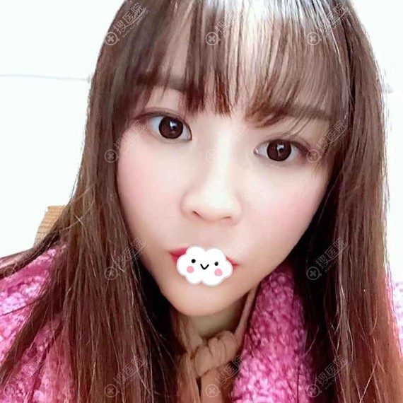 成都艾米丽自体脂肪面部填充效果怎么样?潘红伟案例 成都艾米丽自体脂肪面部填充效果怎么样?潘红伟案例