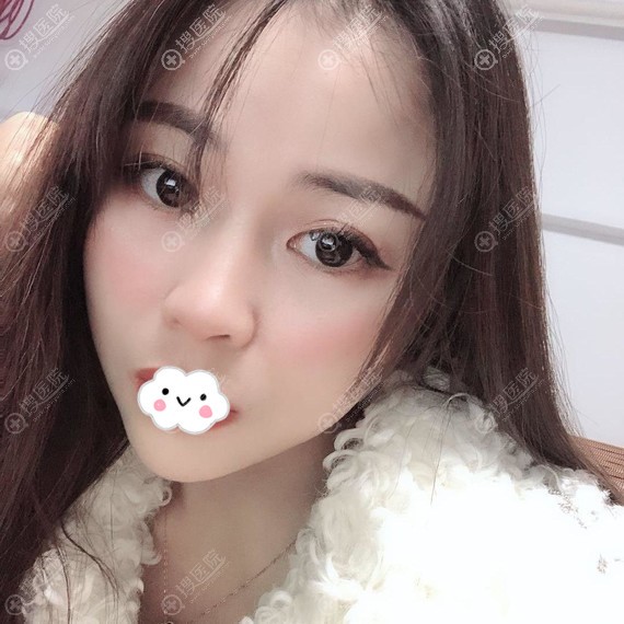 成都自体脂肪面部填充哪家医院好?艾米丽潘红伟案例 成都自体脂肪面部填充哪家医院好?艾米丽潘红伟案例
