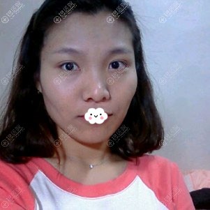 广州自体脂肪面部填充多少钱?1W多找广州曙光万友望填充案例图