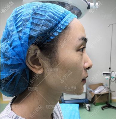 详细记录我去绵阳朗睿整形医院找杨俊做鼻综合隆鼻的心路历程