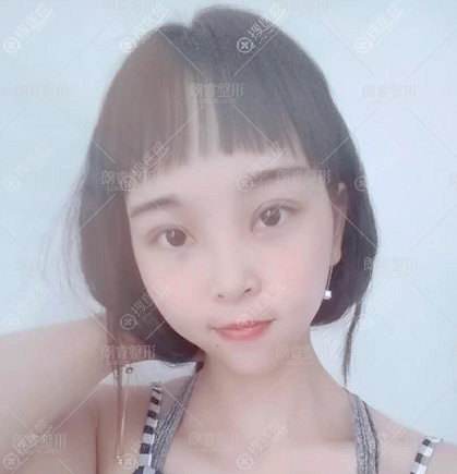 <!--<i data=20240710 data-id=12143></i>-->整形医院双眼皮术后7天拆线效果 <!--<i data=20240710 data-id=12143></i>-->整形医院双眼皮术后7天拆线效果