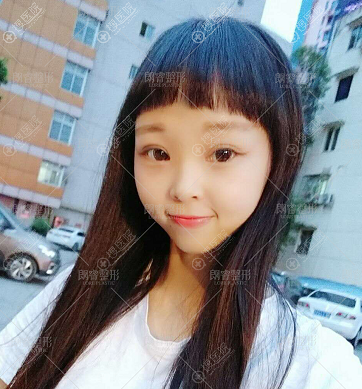四川<!--<i data=20240710 data-id=12143></i>-->做双眼皮怎么样 四川<!--<i data=20240710 data-id=12143></i>-->做双眼皮怎么样