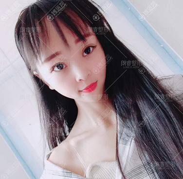 四川<!--<i data=20240710 data-id=12143></i>-->刘锋医生做的双眼皮案例 四川<!--<i data=20240710 data-id=12143></i>-->刘锋医生做的双眼皮案例
