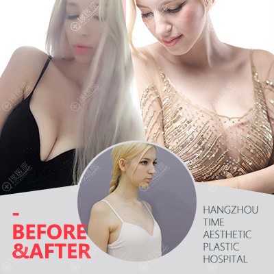 杭州时光黄良飞假体隆胸案例 杭州时光黄良飞假体隆胸案例