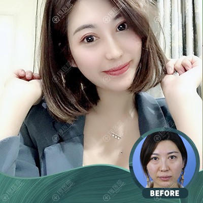 杭州时光黄良飞内切祛眼袋案例 杭州时光黄良飞内切祛眼袋案例
