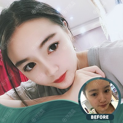 杭州时光胡斌院长肋软骨隆鼻案例 杭州时光胡斌院长肋软骨隆鼻案例